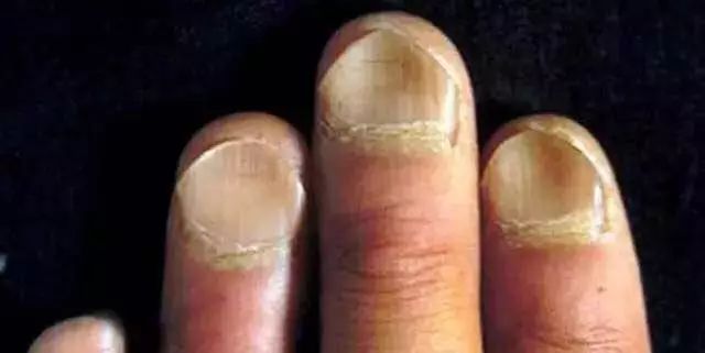 指甲上的月牙、竖纹代表什么 这8种指甲问题一